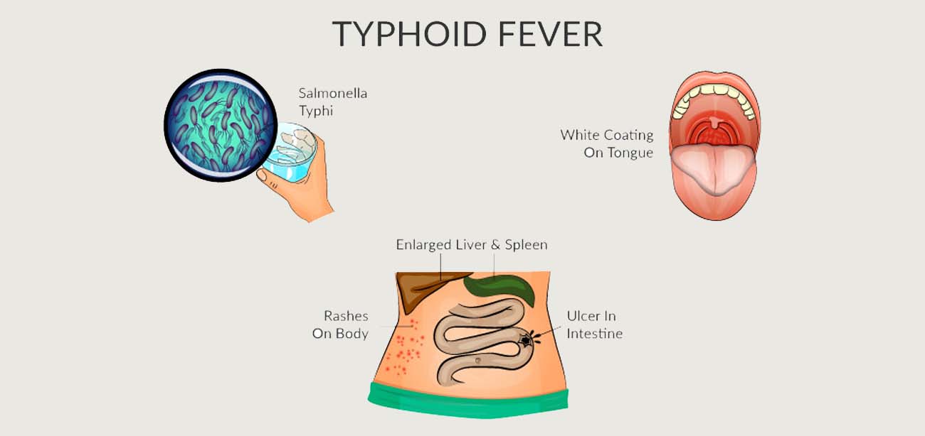 You are currently viewing Typhoid Fever