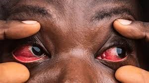 You are currently viewing CONJUNCTIVITIS(PINK/RED EYE DISEASE)